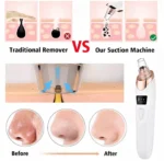 5-in-1 Blackhead Remover Machine - Image 3